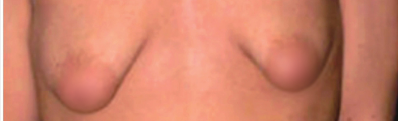 遗传性乳腺发育不良影响泌乳量_泌乳期产奶量_遗传激素水平异常与母乳分泌