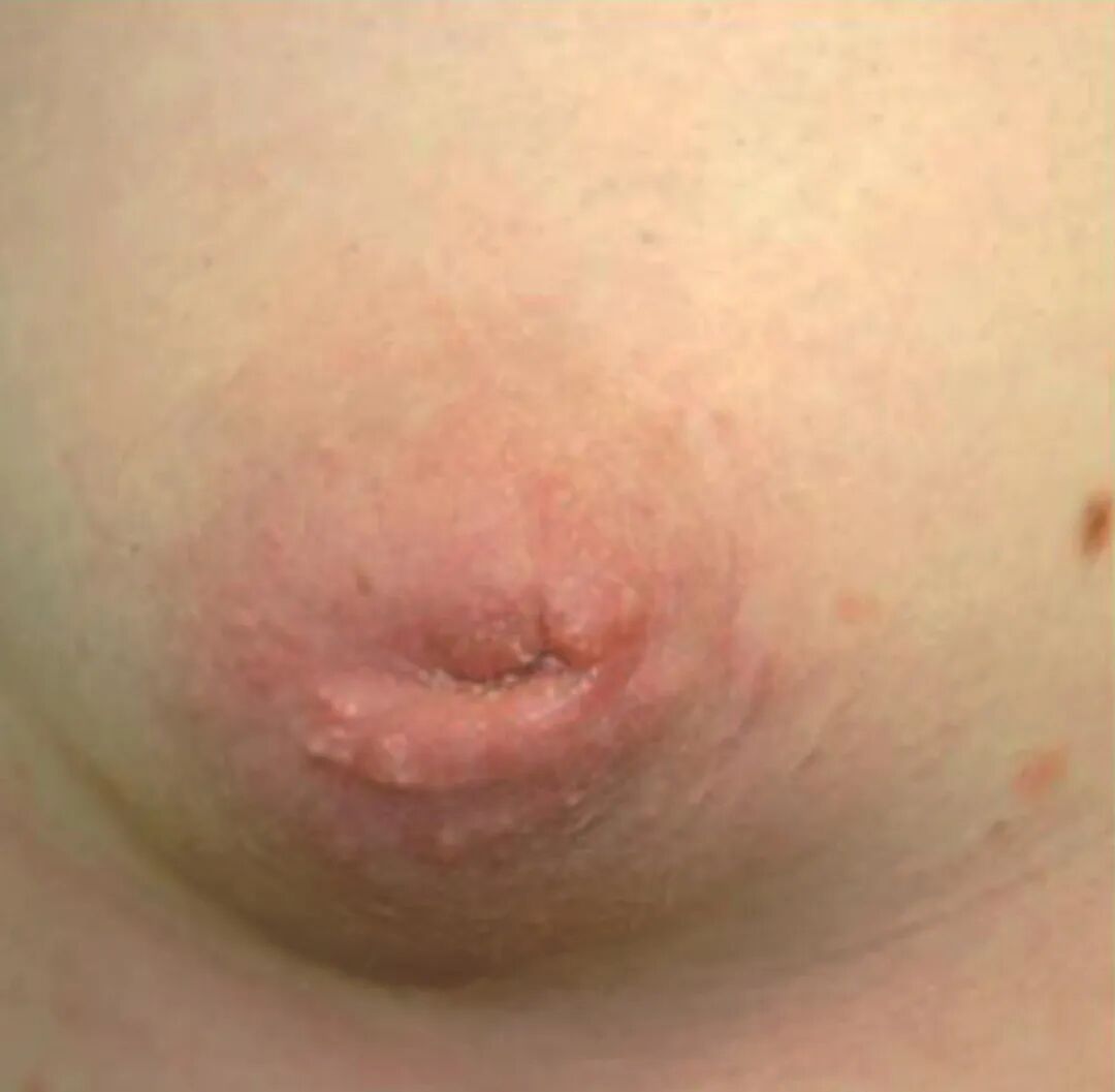 遗传激素水平异常与母乳分泌_遗传性乳腺发育不良影响泌乳量_泌乳期产奶量