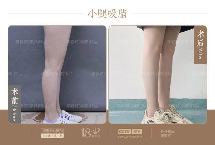 吸脂瘦腿手术_面部抽脂后会反弹吗_潍坊医学院整形外科医院