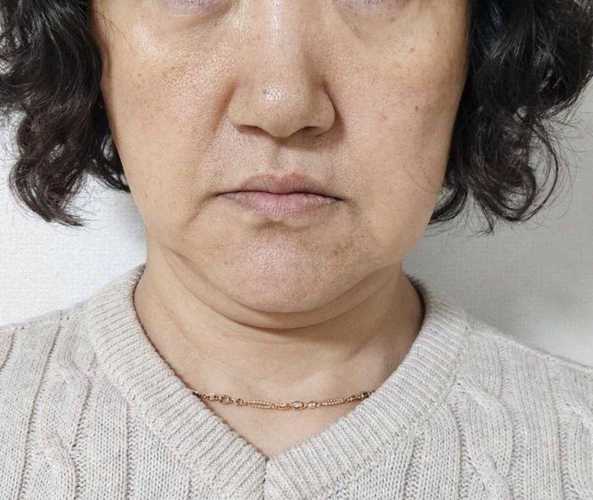 抽脂减肥效果持久吗_面部抽脂后会反弹吗_脂肪细胞数量变化