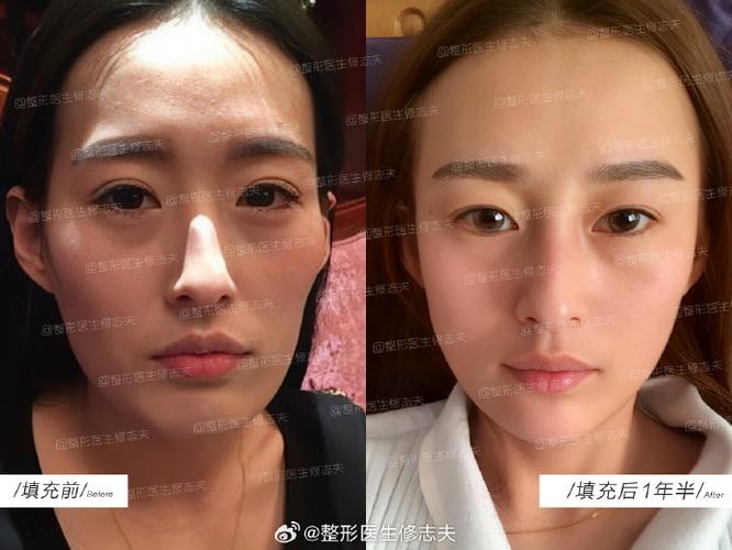 面部抽脂后会反弹吗_整形手术合适年龄_玻尿酸质量判断标准